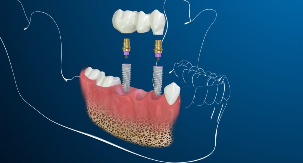 Οδοντικό Εμφύτευμα